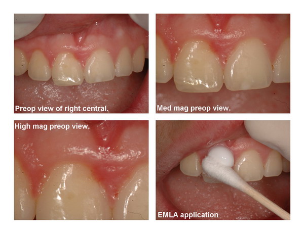 Gingivectomy and restoration Page1_resize.jpg